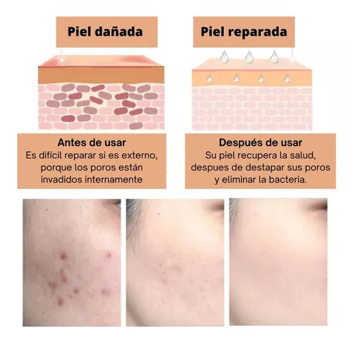 Gel Para El Acné-cicatrices