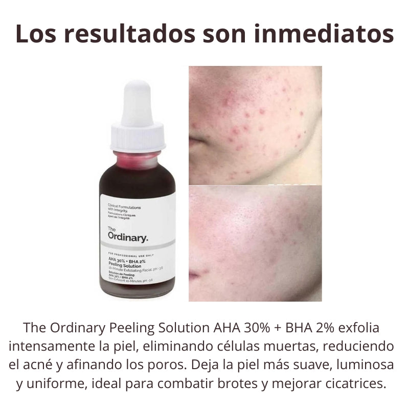 The Ordinary Peeling Solution AHA 30% + BHA 2%, 30ml: Resultados Inmediatos en 10 minutos