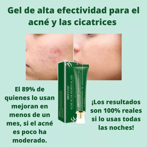 Gel Para El Acné-cicatrices